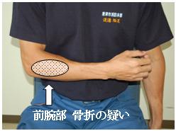 骨折の部位を確認するの画像